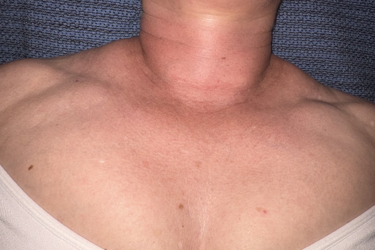 Neck and thyroidectomy scar after 45 minutes of light-touch ScarWork, with visibly softer tissue