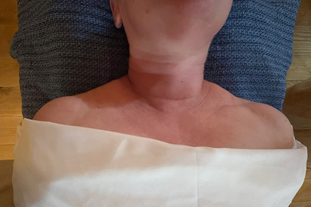 Neck and thyroidectomy scar before 45 minutes of light-touch ScarWork